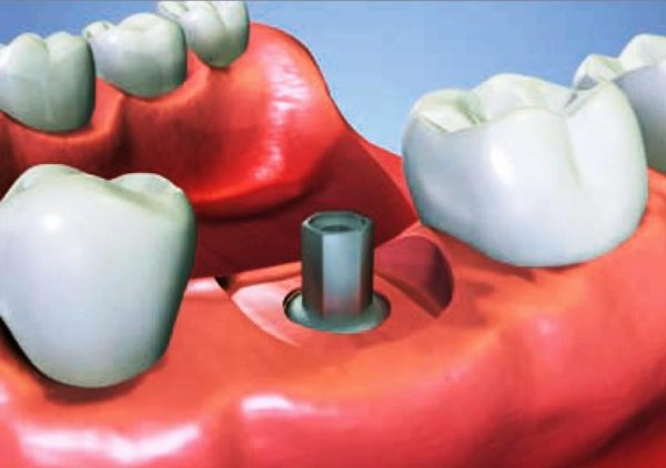 Infeccion implante dental Barcelona