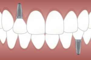 Implante odontologico Barcelona